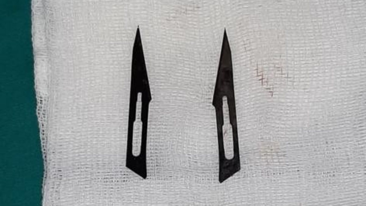 Ankara’da bir kadının midesinden 2 adet neşter çıkarıldı