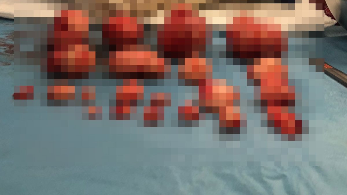 Bursa’da, kadının rahminden 21 miyom çıktı