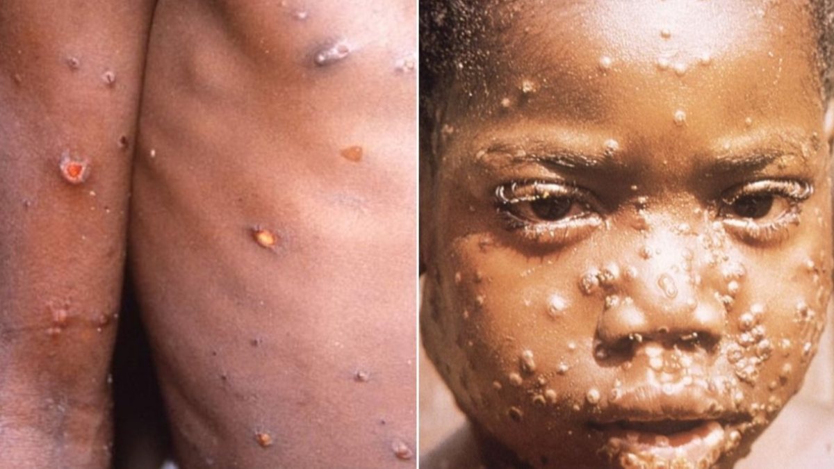 Maymun çiçeği nasıl yayılır: Yeni hastalığı anlamanın 5 yolu