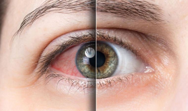 Uzmanından gözlerdeki kaşınmaya ilişkin açıklama