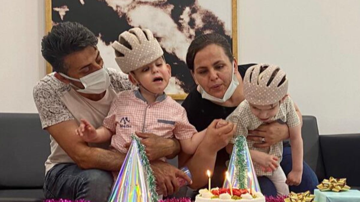 Cumhurbaşkanı himayesinde ayrılan siyam ikizleri 4 yaşında