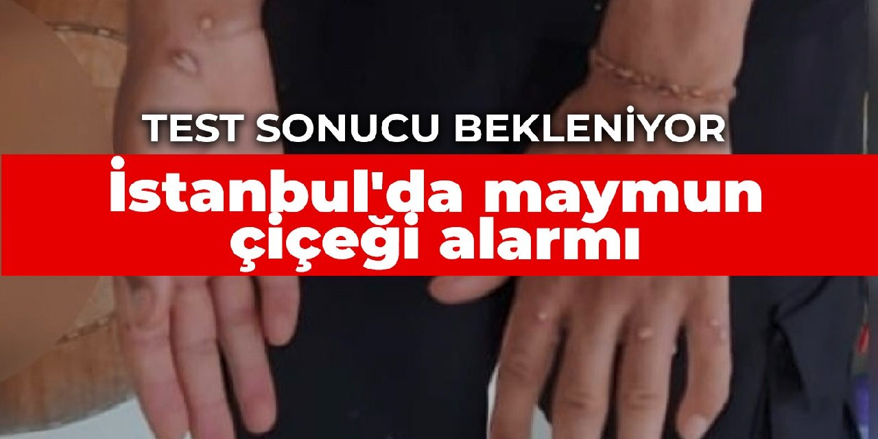 İstanbul’da maymun çiçeği alarmı: Test sonucu bekleniyor