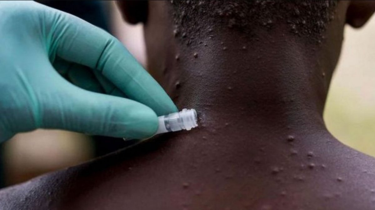 Nijerya’da maymun çiçeğine karşı vahşi hayvan eti satışı yasaklandı