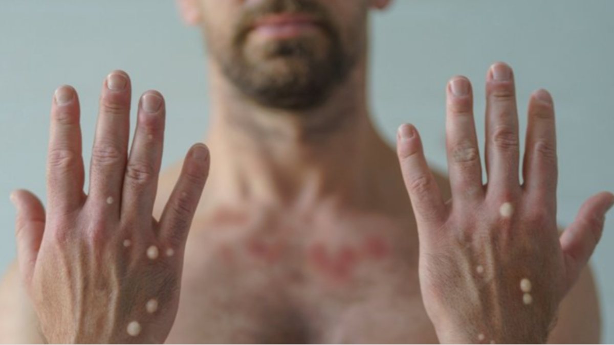 Türkiye’de maymun çiçeği vakası görüldü: Belirtileri neler, kimler risk altında