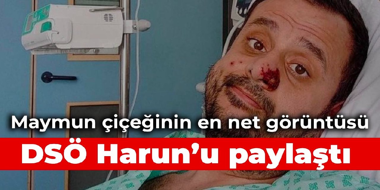 DSÖ maymun çiçeğine yakalanan Harun’un fotoğraflarını paylaştı