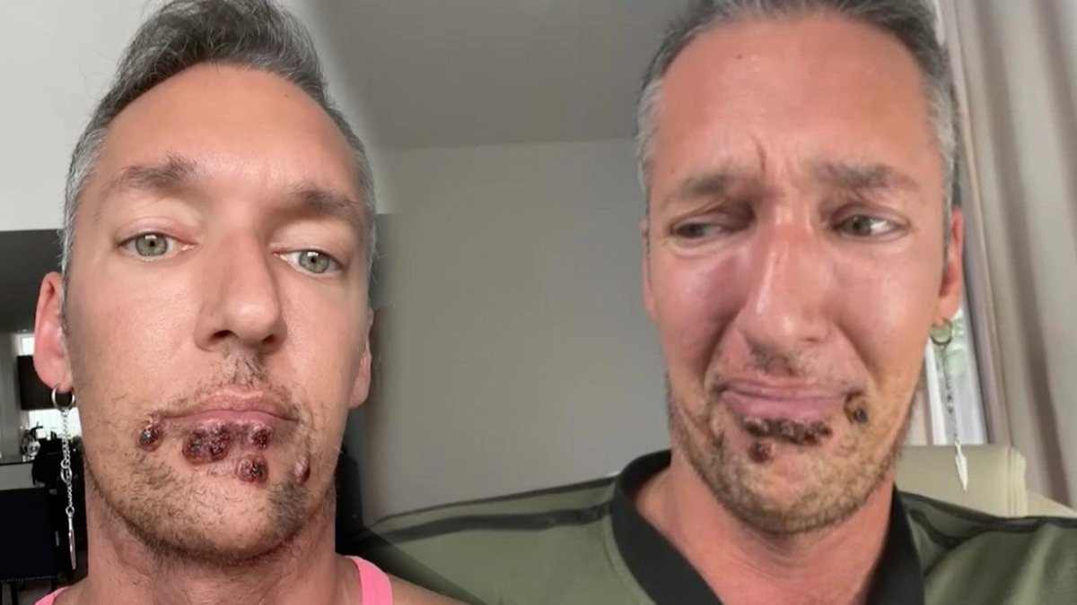 Maymun çiçeği belirtileri hangi sırayla ortaya çıkıyor?