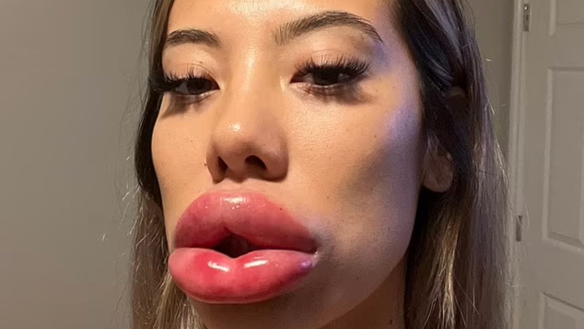 ABD’de dolgu yaptıran kadının dudakları orantısız büyüdü