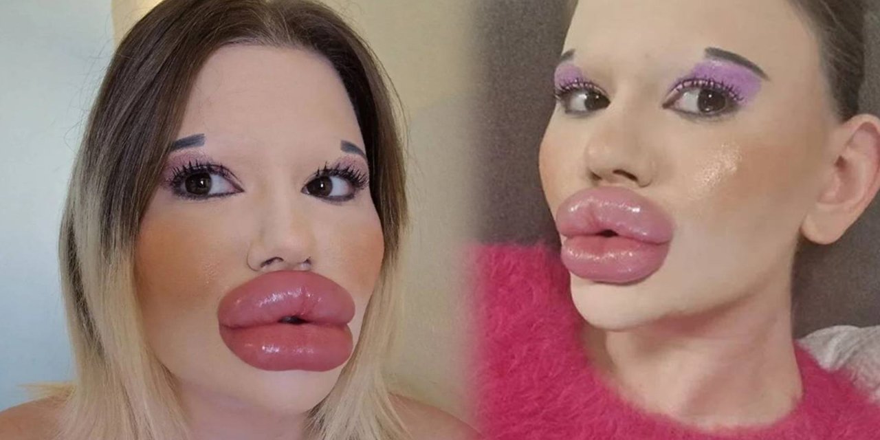 Doktorların ölüm uyarılarını hiçe sayıyor: Dudak estetiğine dudak uçuklatan servet