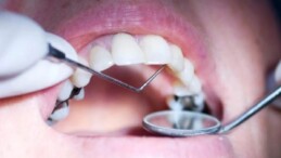 Amalgam Güvenli İse Diş Hekimim Bunu Kullanmak İçin Neden Önlem Alıyor?