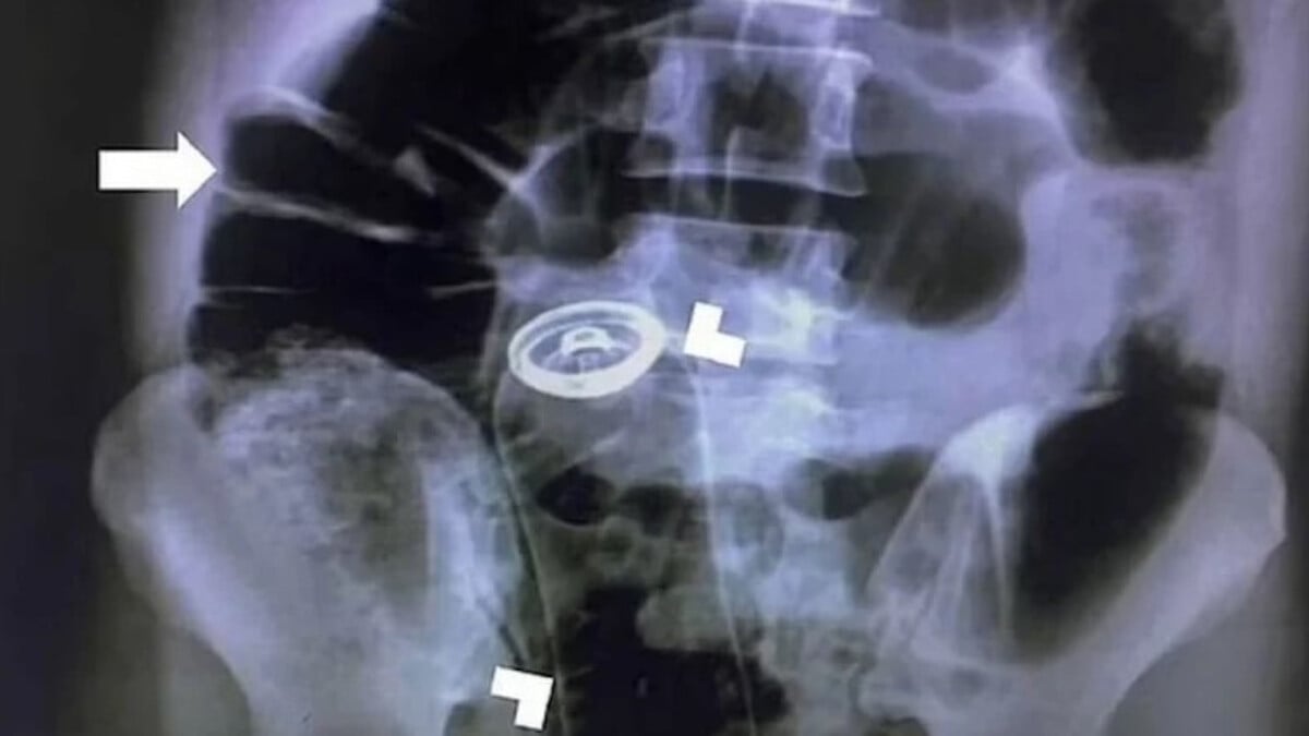 İran’da 30 yaşındaki adamın makatından deodorant şişesi çıktı