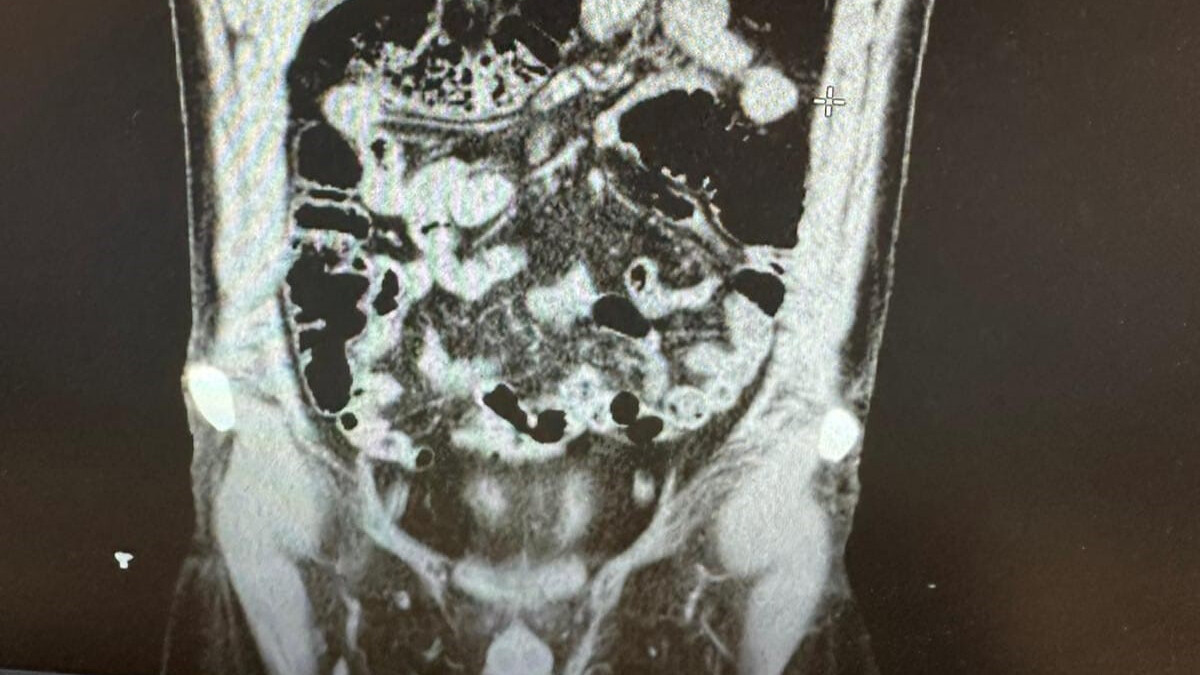 Konya’da midesinden eroin çıkan İranlı kuryenin savunması şaşırttı
