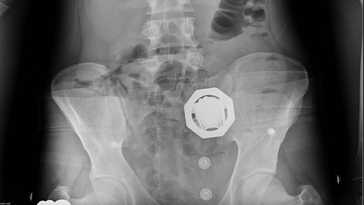 Diyarbakır’da 4 şüphelinin midesinden 840 gram eroin çıktı