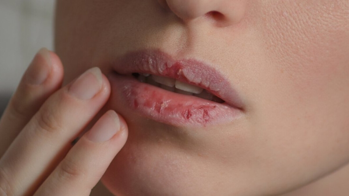 Dudaklarınız o hastalıkların sinyali olabilir! Eğer soluk dudaklara sahipseniz…