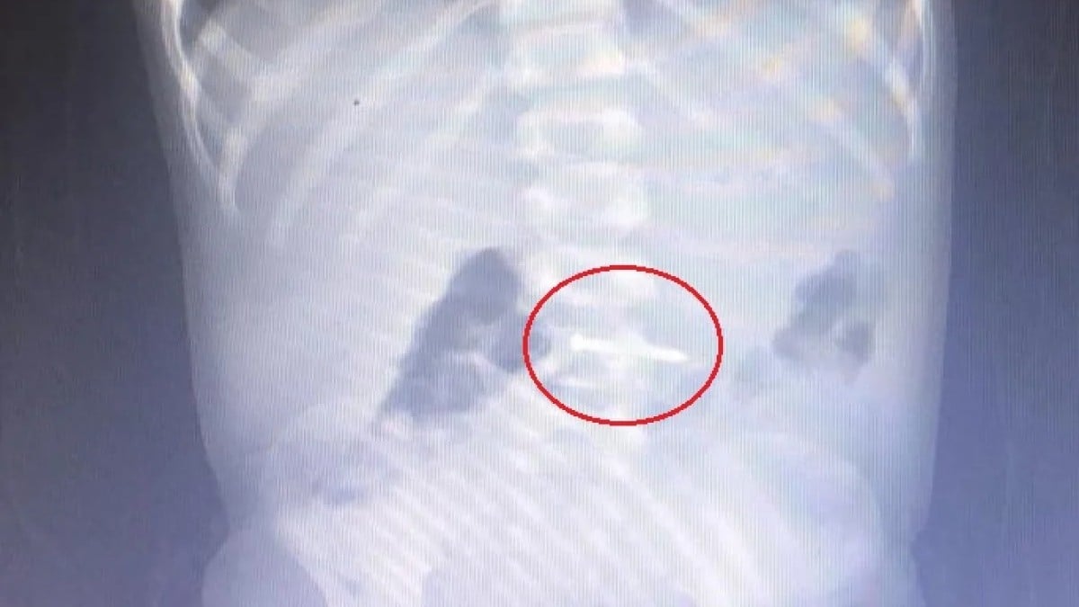 Bursa’da oyun oynayan 2 yaşındaki çocuk çivi yuttu