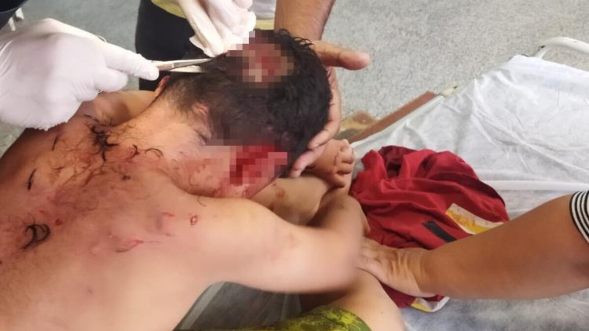 Gaziantep’te 8 yaşındaki çocuğa köpek saldırdı: Kafatasında derin yaralar oluştu