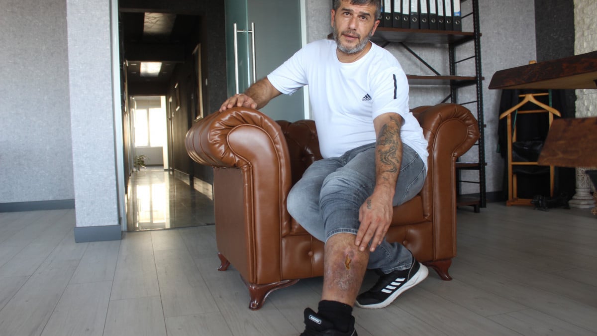 Kayseri’de bacağında unutulan bez parçasıyla 16 yıl yaşadı