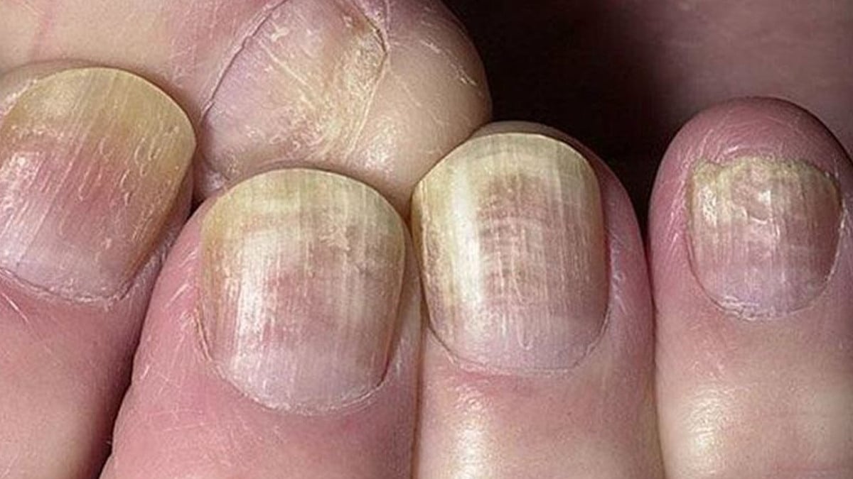Tırnaklarınız uyarıyor! Eğer tırnaklarınızda bunlar varsa hasta olabilirsiniz…