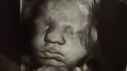 ABD’deki çift rahimli kadın aynı anda iki farklı bebeğe hamile kaldı