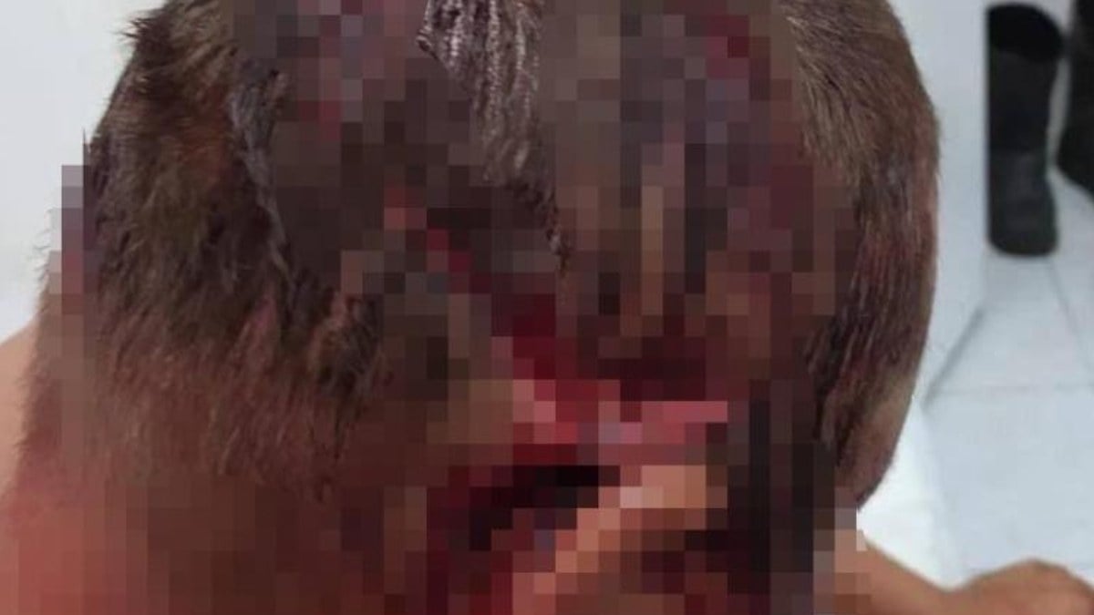 Mardin’de ayı saldırısında ağır yaralandı