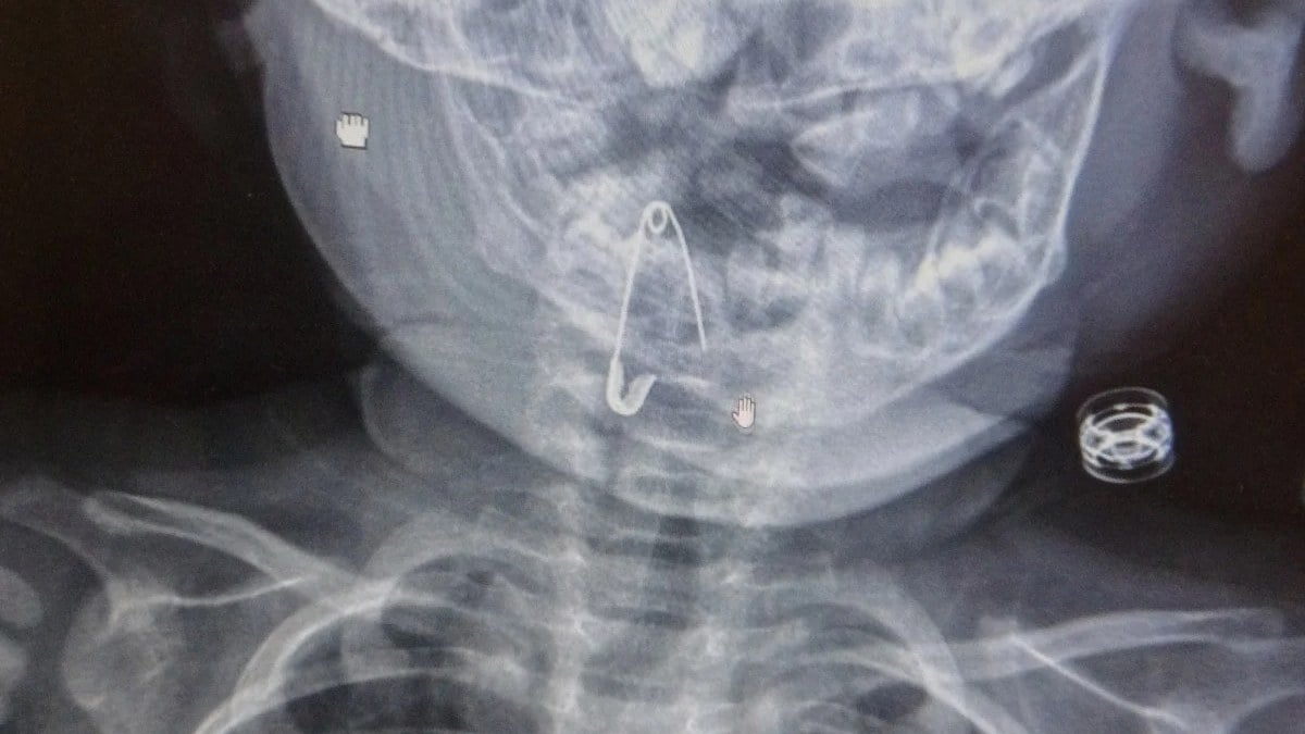 Bitlis’te 8 aylık bebeğin boğazına kaçan çengelli iğne operasyonla çıkartıldı