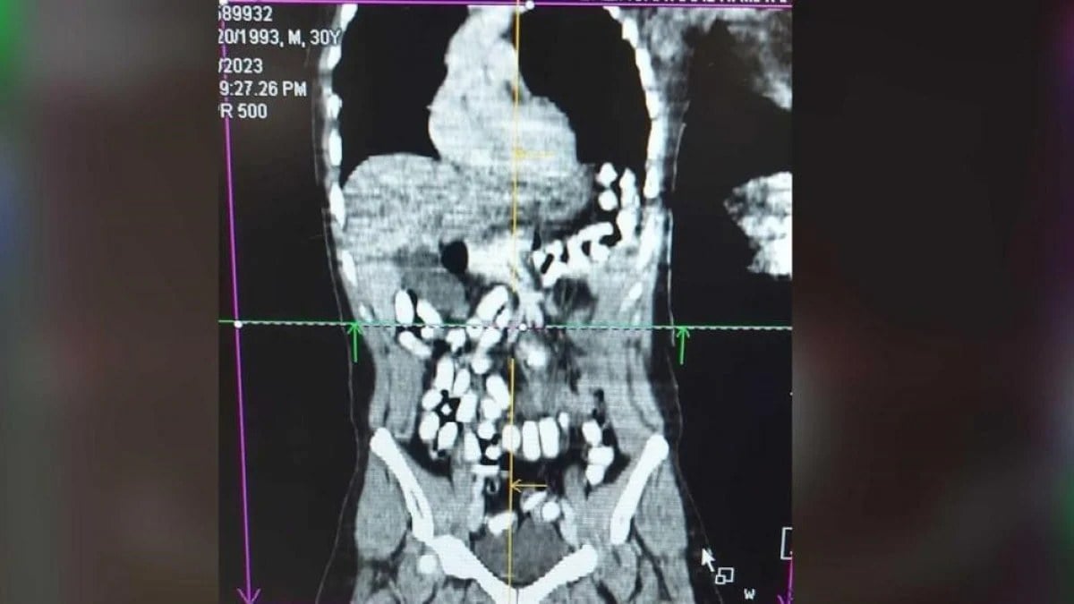 Erzincan’da midesinde uyuşturucu taşıyan şahıs tutuklandı