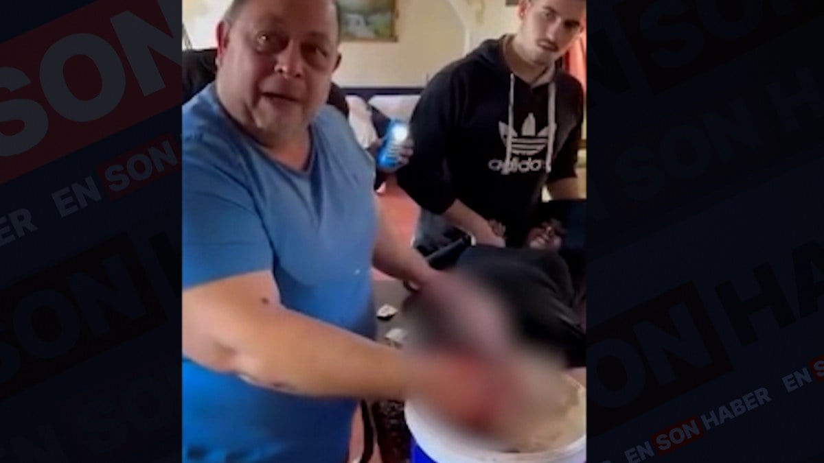 Gazze’deki doktor, yeğeninin bacağını anestezi olmadan kesmek zorunda kaldı