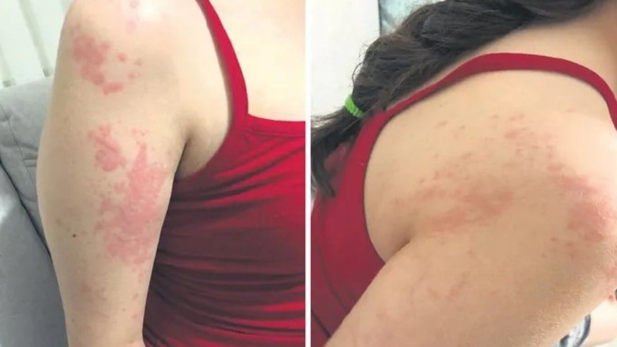 Kocaeli’de hasta kızına verilen ilaç, alerjiye neden oldu