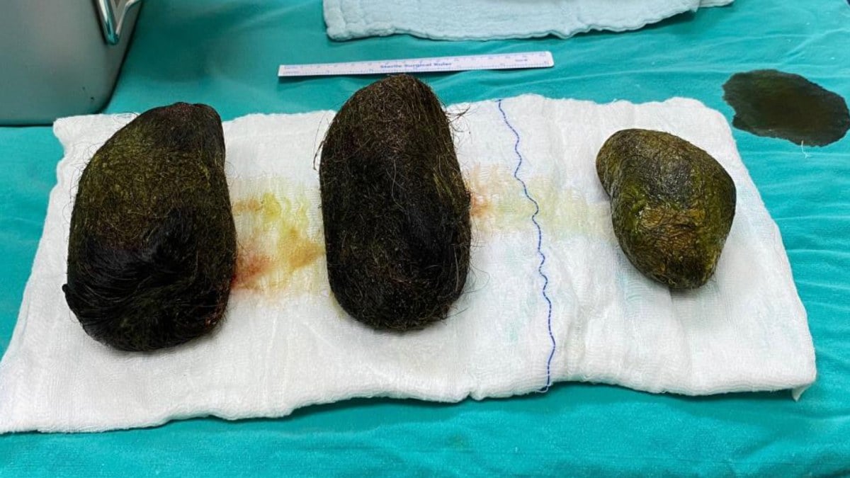 Osmaniye’de karın ağrısı şikayetiyle hastaneye gitti midesinden 2 kilo saç çıktı