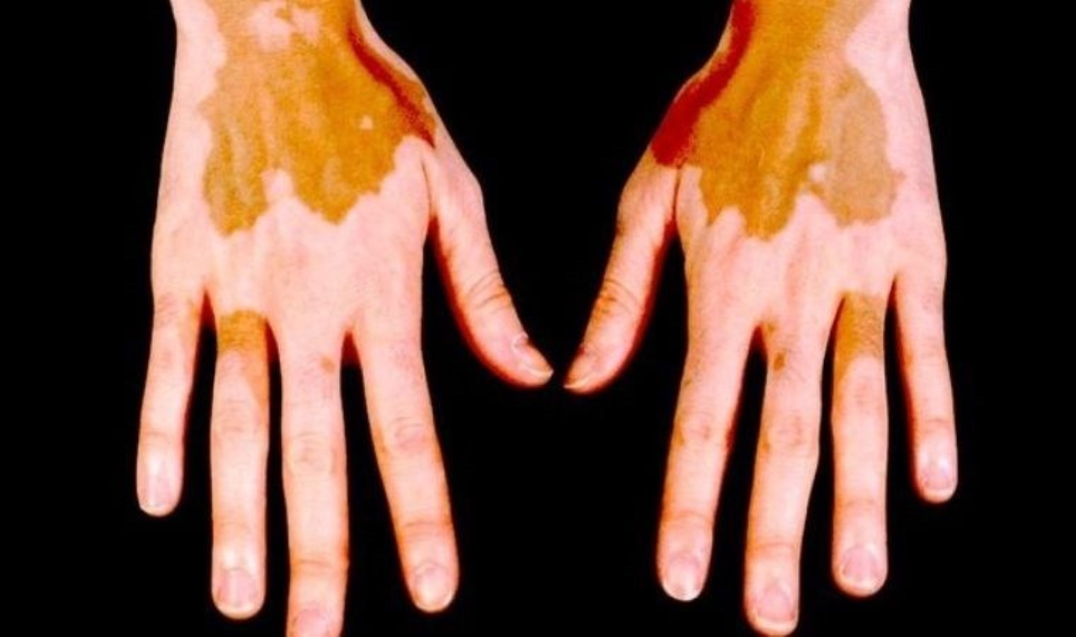 Addison hastalığı nedir? Addison hastalığı belirtileri nelerdir?