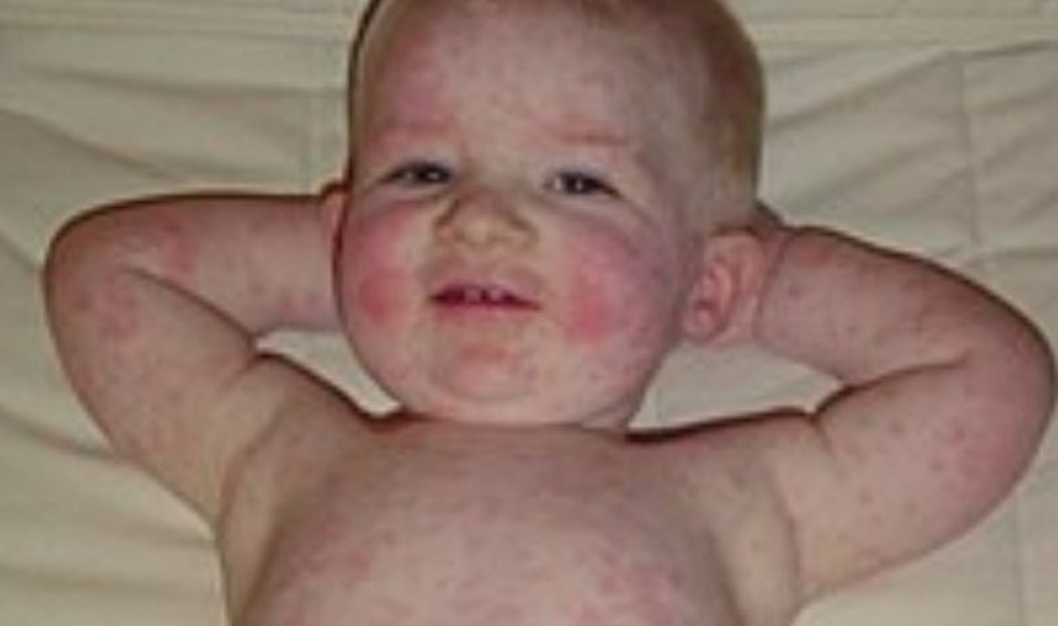 Beşinci hastalık nedir? Beşinci hastalık belirtileri neler? Beşinci hastalık bulaşma yolları…