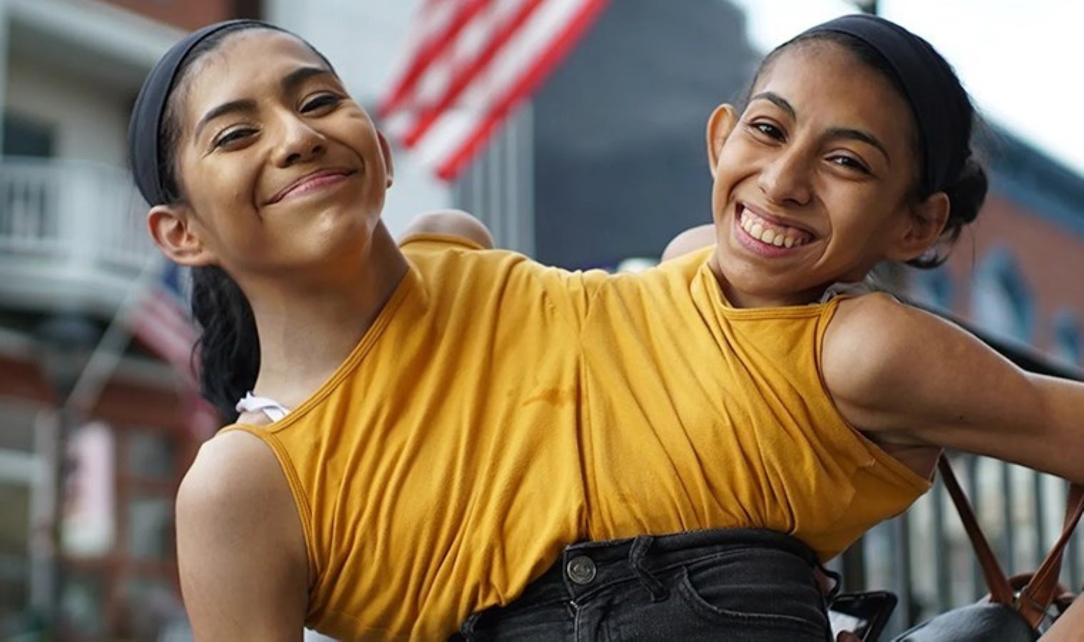 Yapışık ikizlerin ömrü: Biri ölürse başkasına ne olacak?