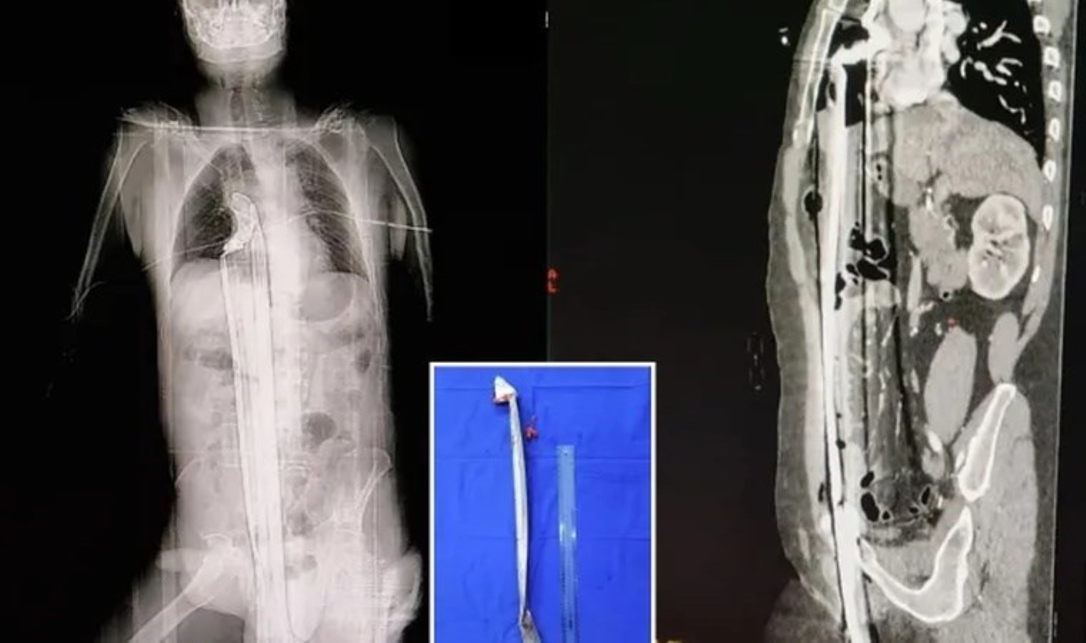 Vefattan ‘mucize’ kurtuluşu tabipleri şaşırttı: 91 cm uzunluğunda demir çubuk çıkarıldı