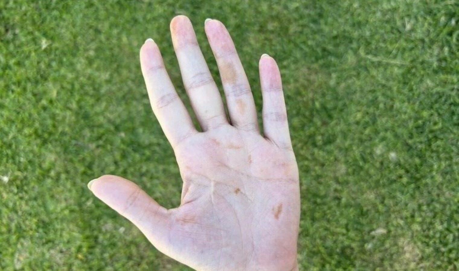 ‘Ayırt edilmesi hayati öneme sahip, deniz suyundan bulaşıyor’: El ve ayaklarda bir gecede ortaya çıkan kahverengi lekeler neyin habercisi?