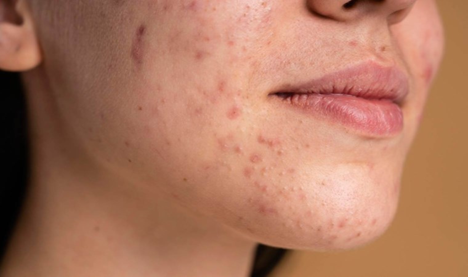 Klozet kapağını açık bırakmak akneye neden oluyor mu?