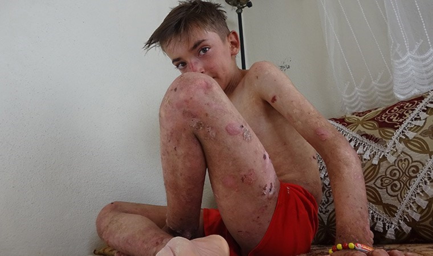 Arkadaşlarının dalga geçtiği ‘deri hastalığından’ kurtulmak istiyor: ‘Vücudum yaralardan sürekli kanıyor’