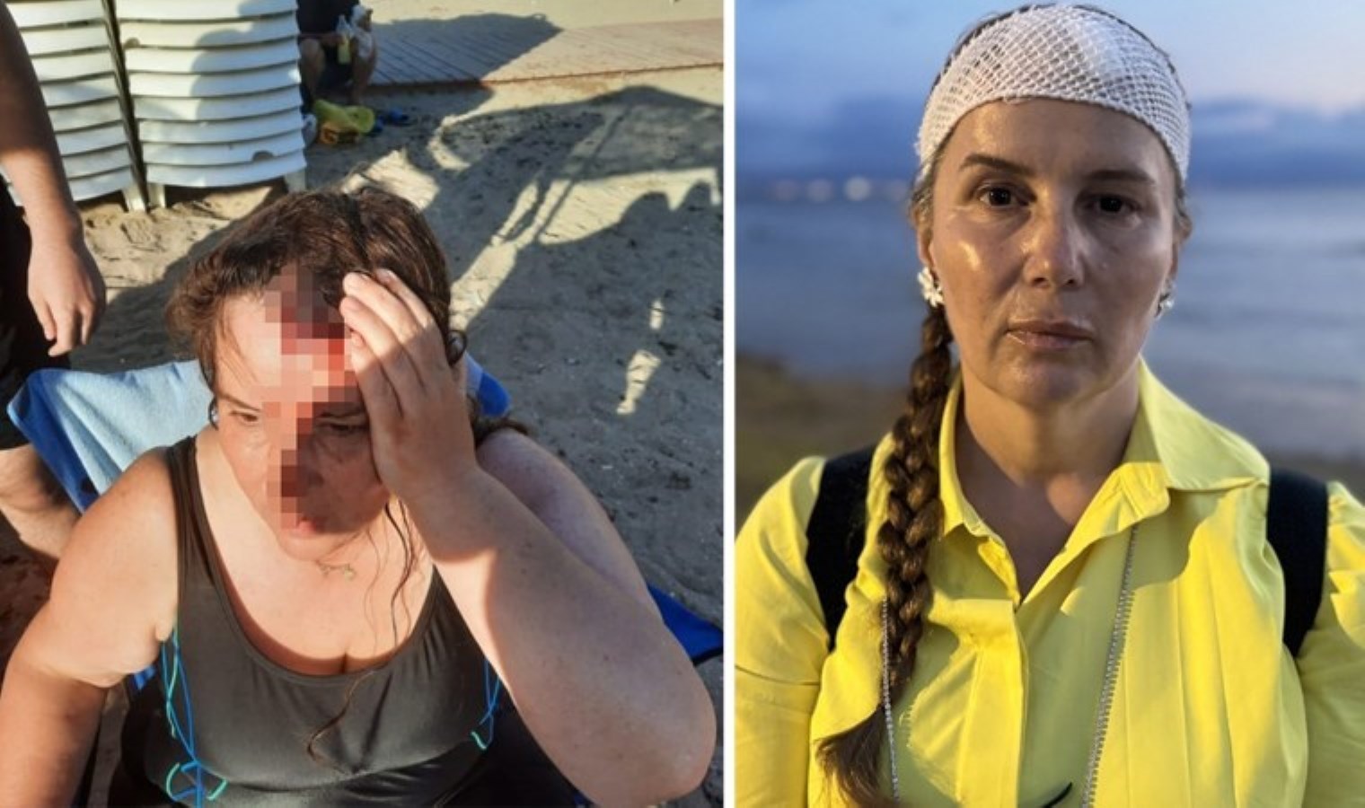 Denizde yüzerken jet ski çarptı, ölümden döndü: ‘Küfrünü etti ve beni orada bırakıp gitti’