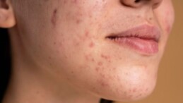 Dermatologlara göre sivilce izlerini geçirmek için yapmanız gereken her şey…