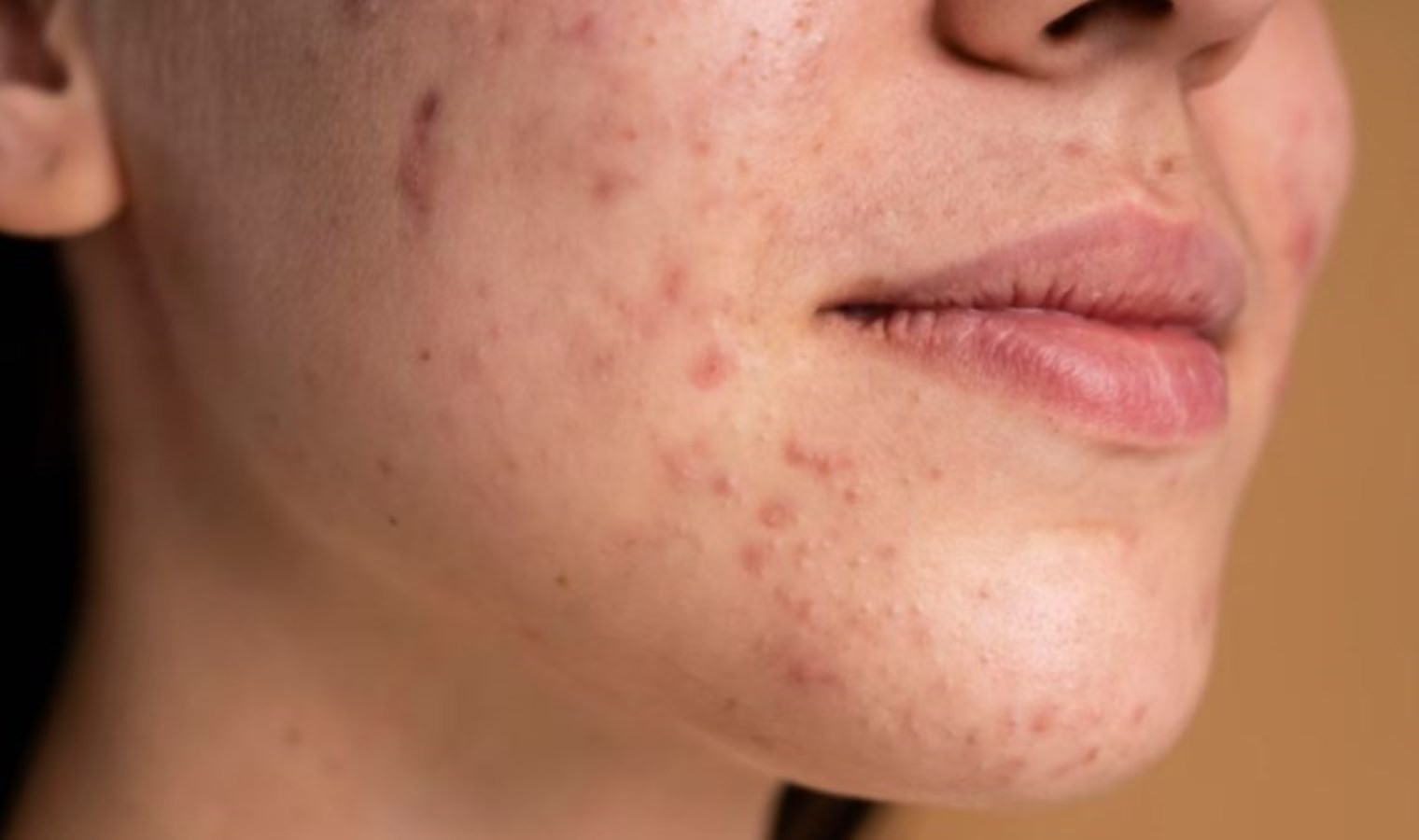 Dermatologlara göre sivilce izlerini geçirmek için yapmanız gereken her şey…
