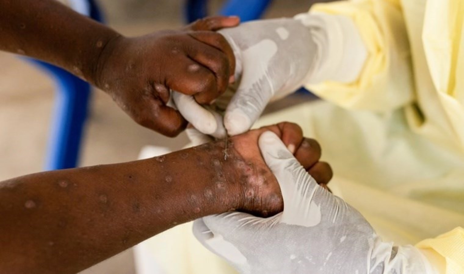 Afrika ülkesinde M çiçeği alarmı: ‘Vakaların çoğu çocuk’