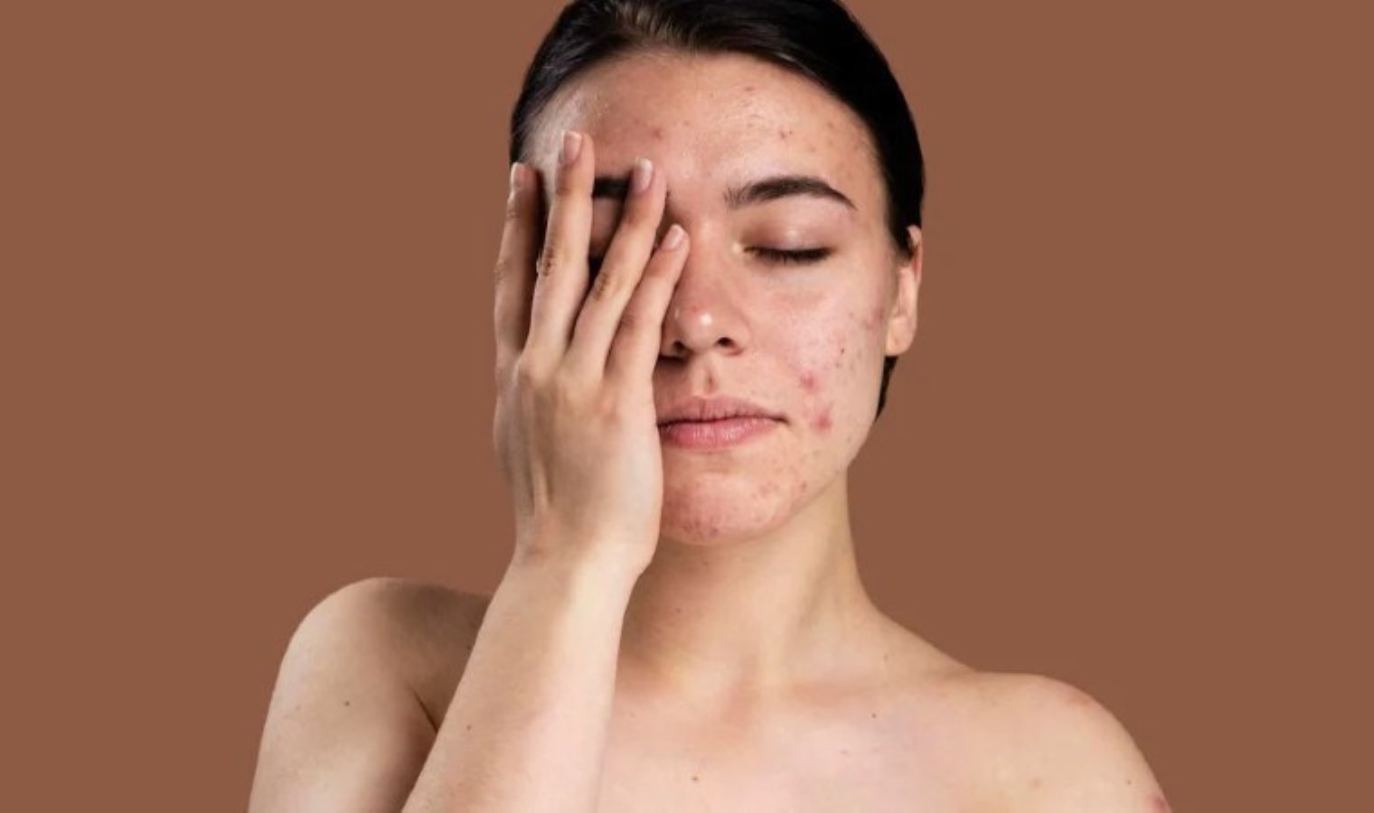 Akne sorununun sebebi olabilir: Glutenin cilt üzerindeki tesirleri