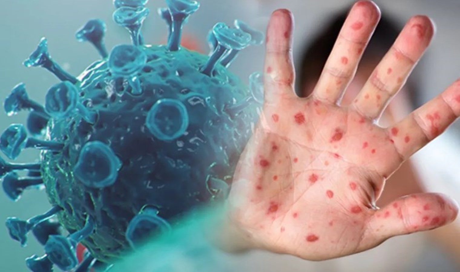 Bir ülke daha maymun çiçeği olayı bildirdi