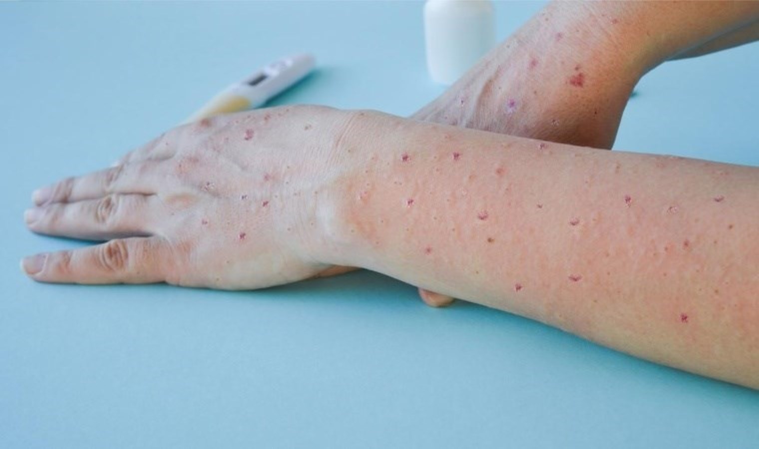 Dünya Sağlık Örgütü’nden M Çiçeği Salgını Raporu