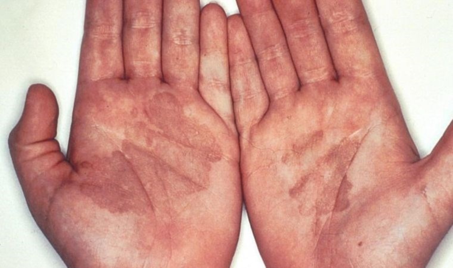 Sabah ellerinizde kına ile uyanmanızın asıl sebebi buymuş: Tinea Nigra enfeksiyonu ve belirtileri