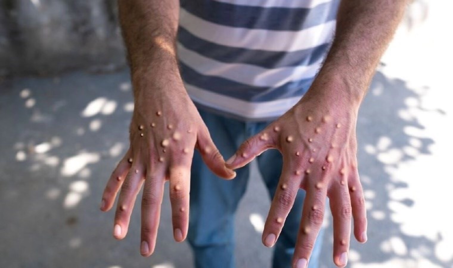 DSÖ’den Afrika uyarısı: 30 bin vaka görüldü