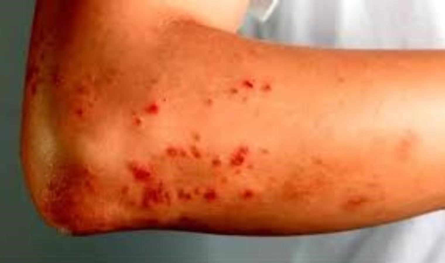 Güroymak’ta şarbon hastalığı tespit edildi