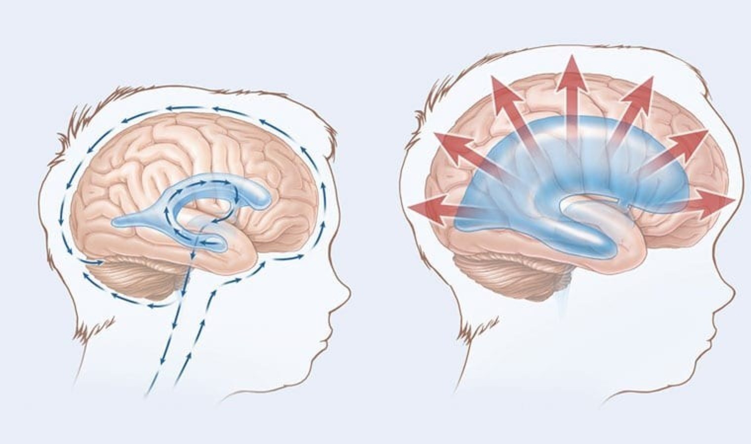 Yaşlılıkta sinsi tehdit: Halk arasında ‘beyinde su toplaması’ olarak geçiyor!