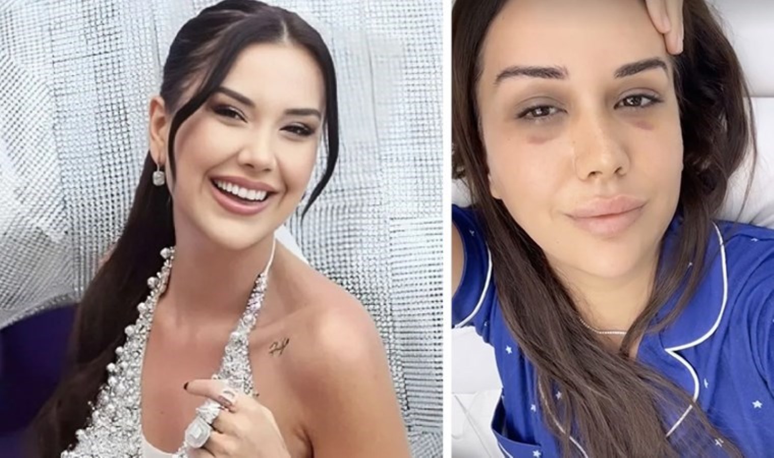 Dilan Polat’ın yüzündeki morlukların nedeni belli oldu