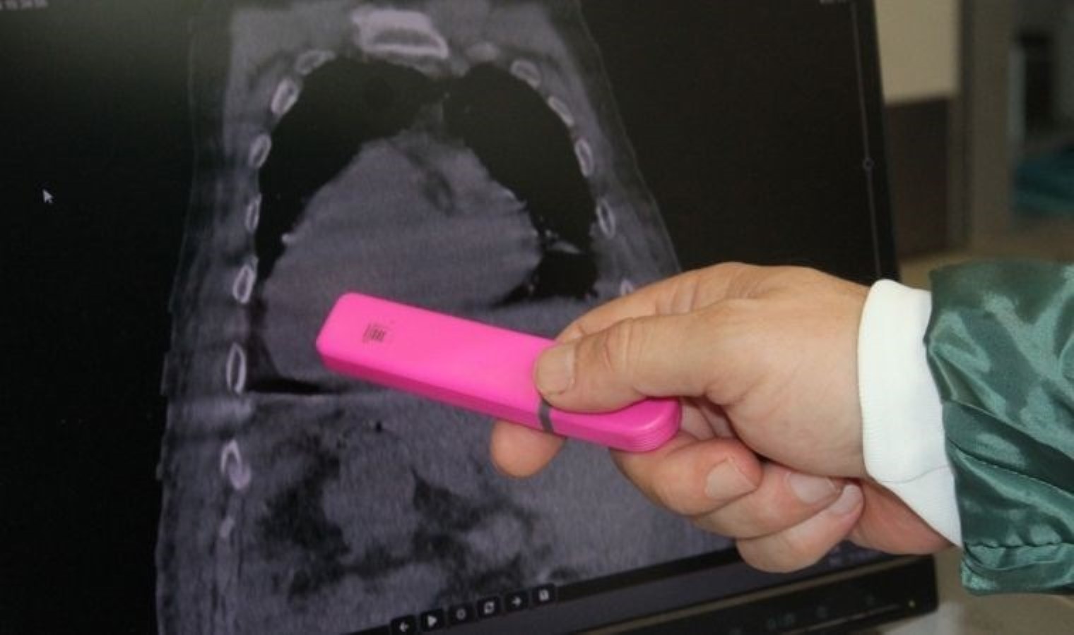 Dünyada ilk kez Türkiye’de görüldü: Giresun Sendromu nedir, belirtileri nelerdir?