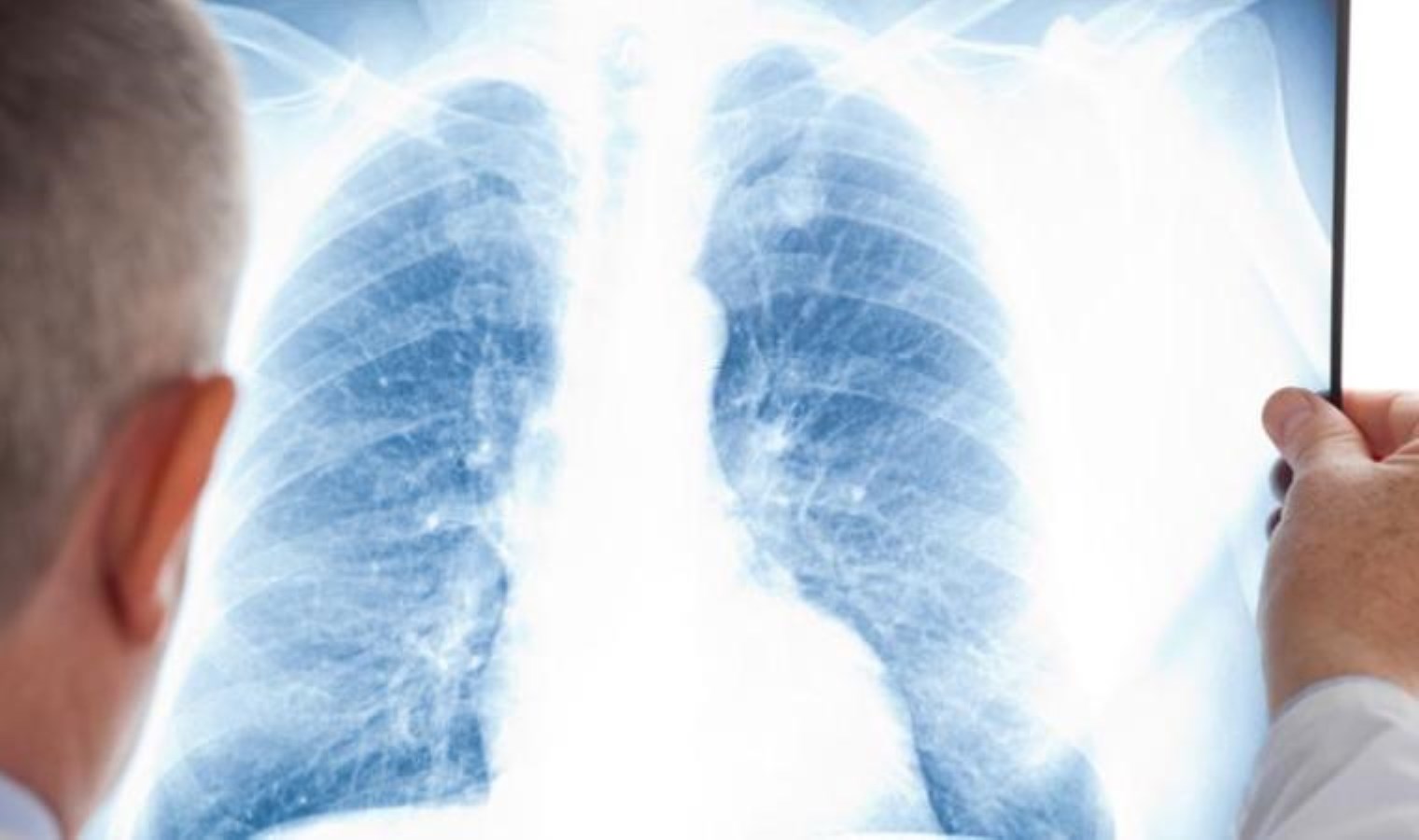 ‘Sigara içmeyen kişilerde de akciğer kanserinin görülme sıklığı giderek artıyor’