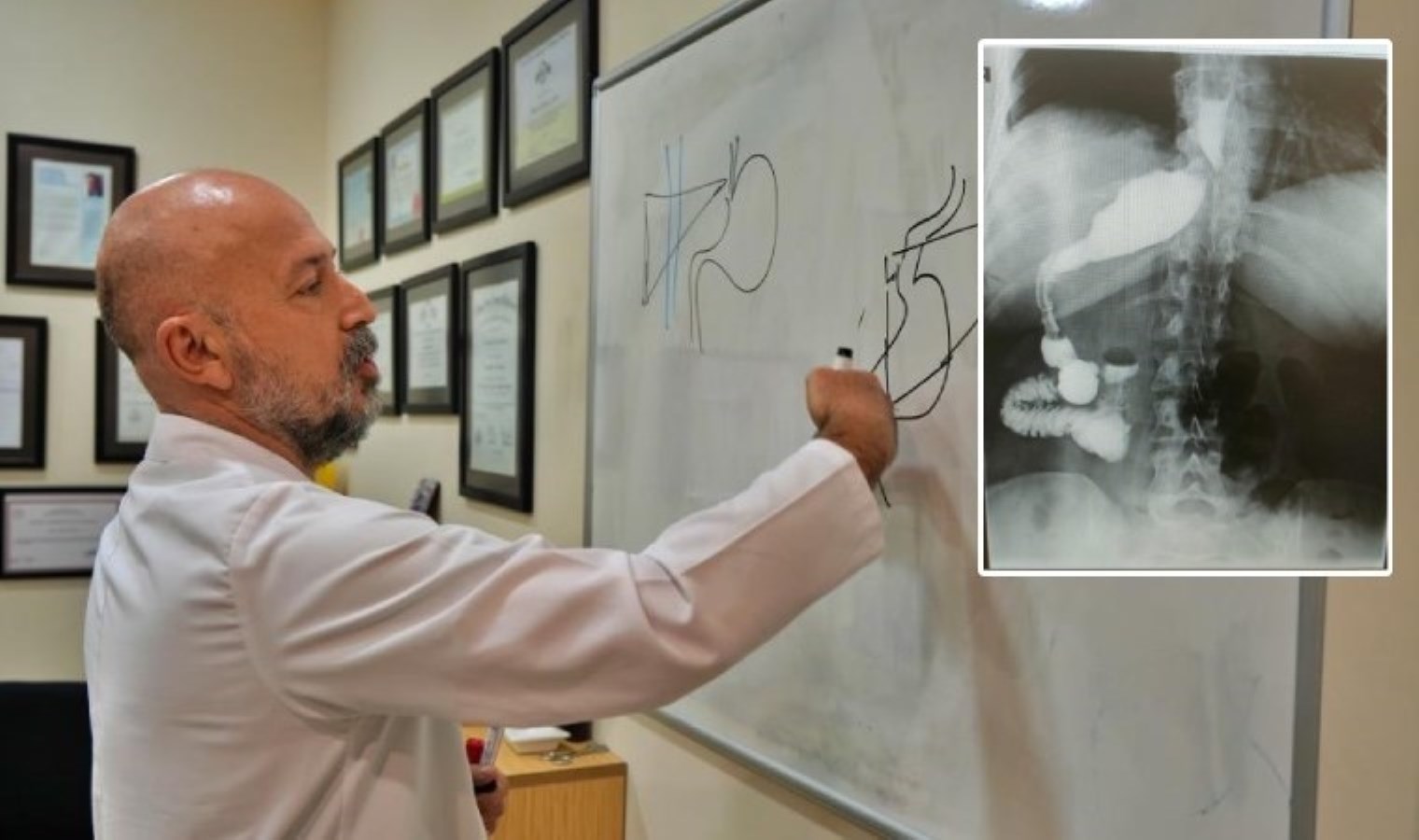 Mide küçültme ameliyatına girdi, doktorlar şoke oldu: ‘Sıra dışı anatomik durum’